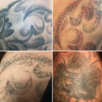 Usuwanie Tatuaży Nowy Sącz