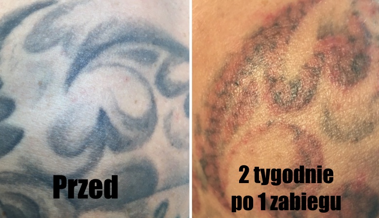 o zabiegu usuwania tatuazy nowy sacz